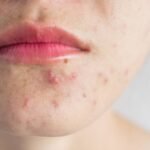 The Acne-Free Confidence Journey: Exploring Professional Pimple Treatment in Islamabad