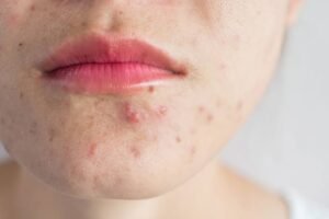 The Acne-Free Confidence Journey: Exploring Professional Pimple Treatment in Islamabad