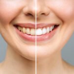 Can Teeth Whitening in Riyadh Remove Years of Tooth Stains?