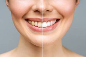 Can Teeth Whitening in Riyadh Remove Years of Tooth Stains?