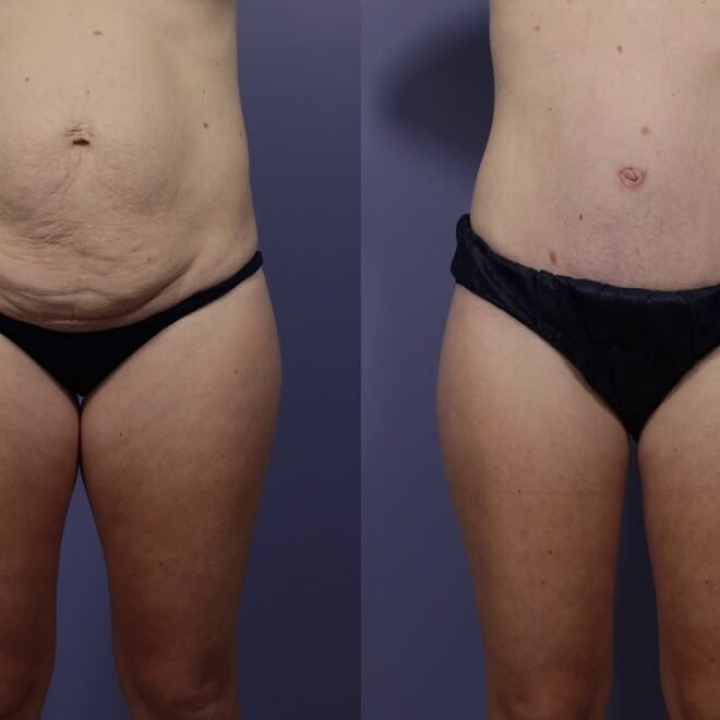 Tummy Tuck in Islamabad: How Modern Aesthetics Redefine Abdominal Beauty