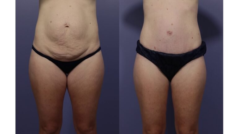Tummy Tuck in Islamabad: How Modern Aesthetics Redefine Abdominal Beauty