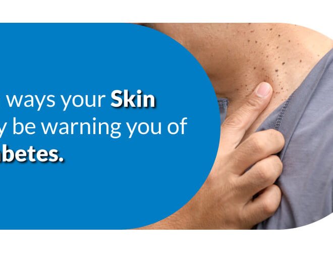 10 Ways Your Skin May Be Warning You of Diabetes
